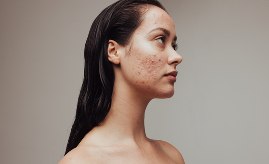 Acne behandelen met rood licht therapie: werkt het echt?.