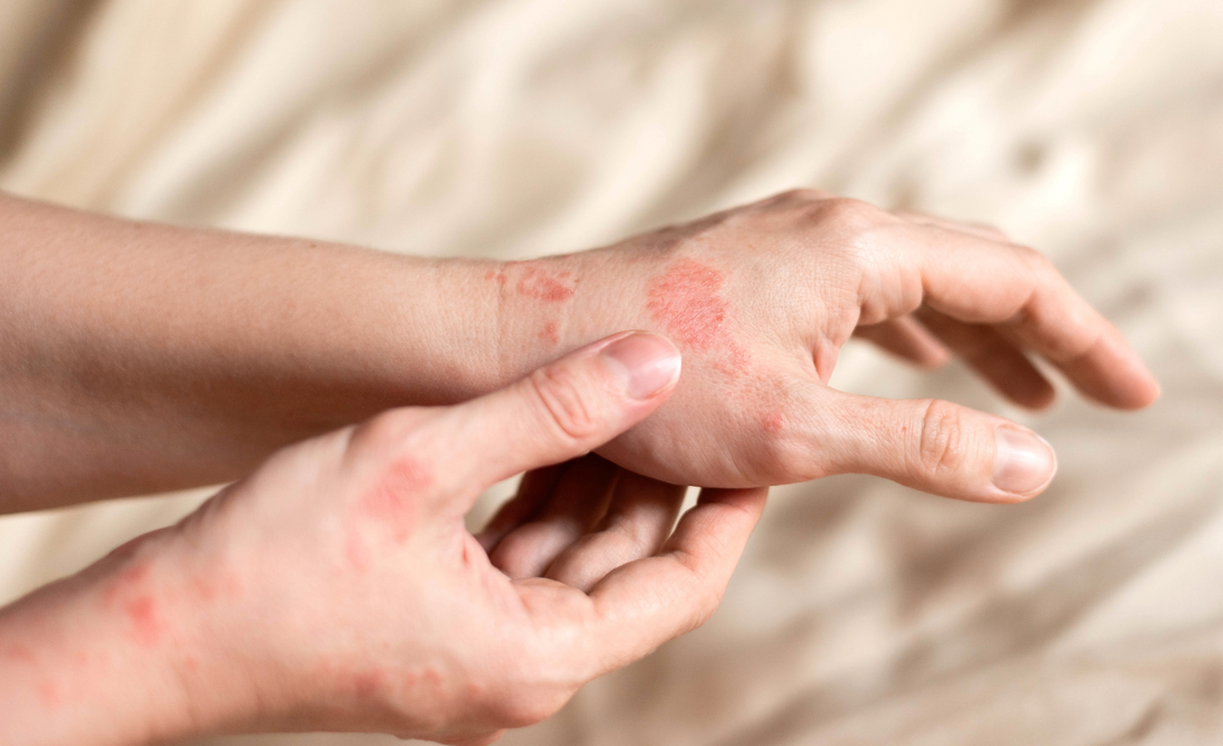 Hoe rood licht therapie helpt bij psoriasis: natuurlijke ontstekingsremmer.